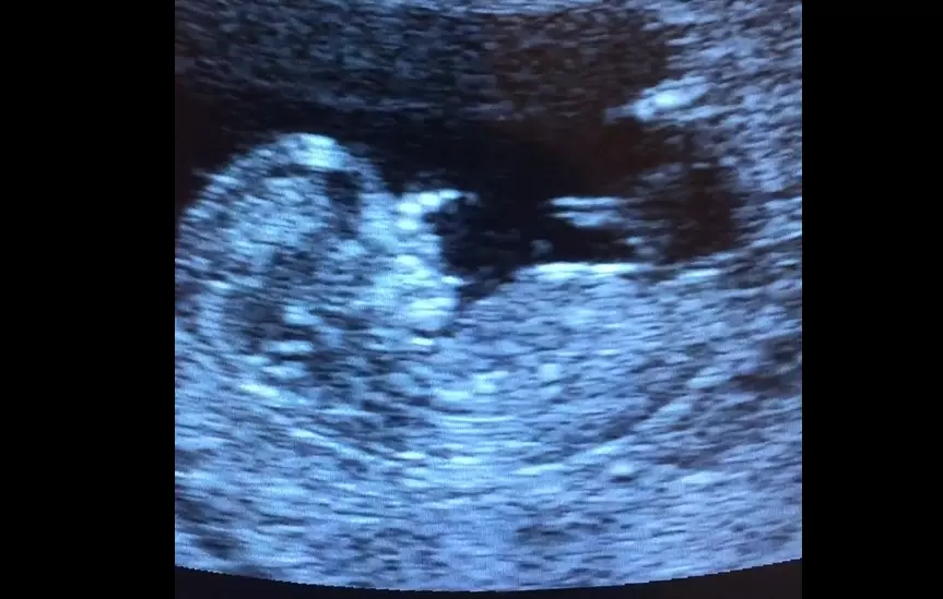 Planned Parenthood tries to say a fetal heartbeat only \