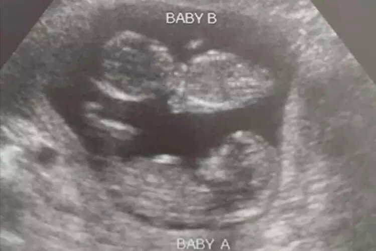 Twin Babies Survive Planned Parenthood Chemical Abortion