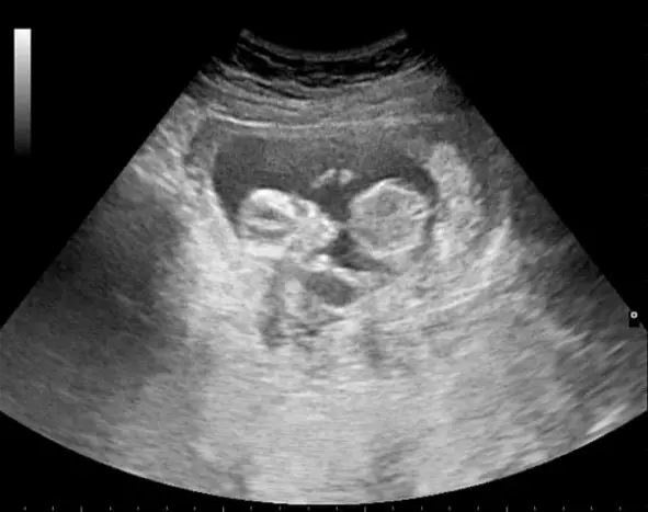 Missouri mom reverses chemical abortion amidst pandemic lockdown, saves unborn baby