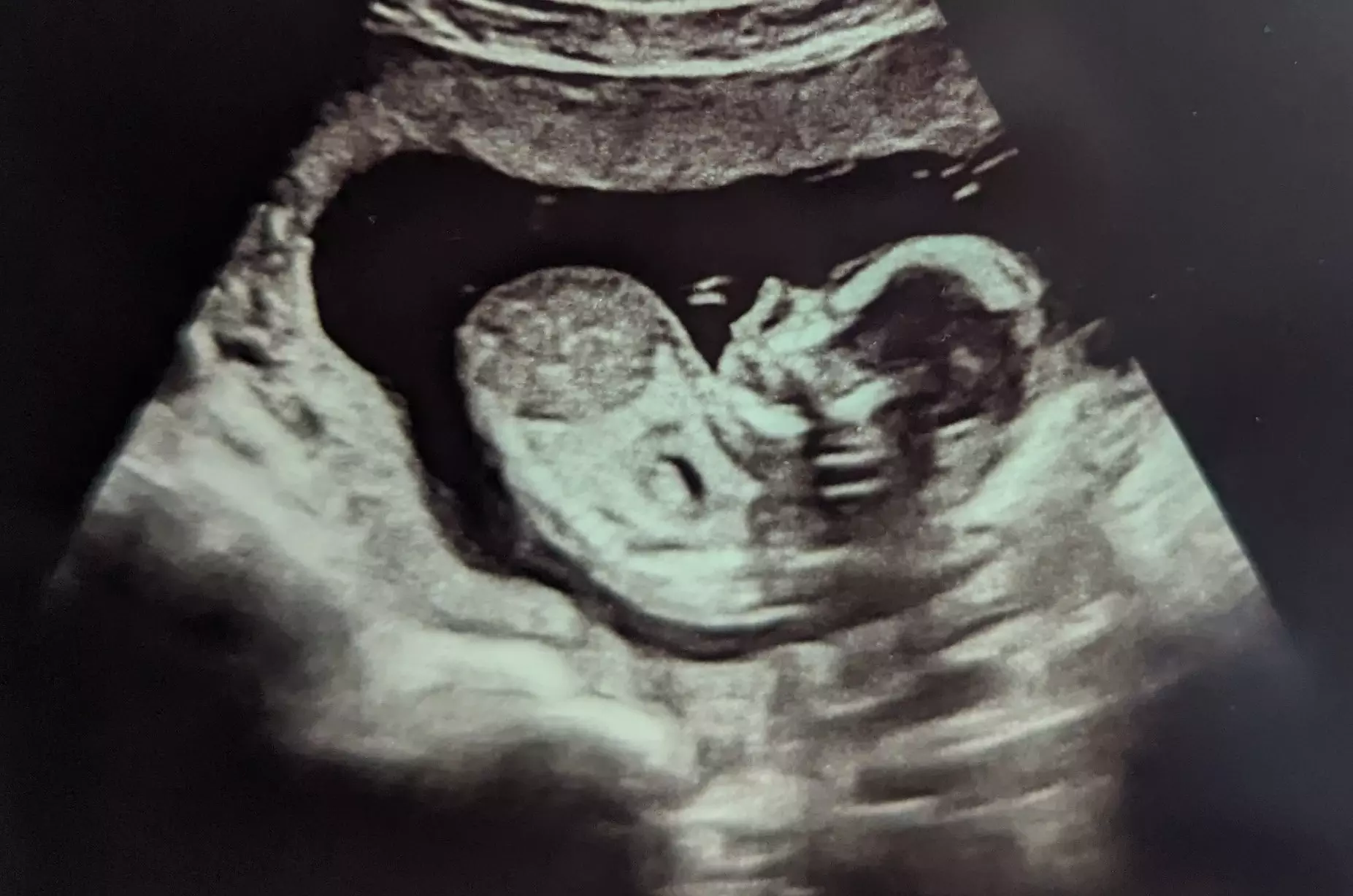 Sarah’s story of Abortion Pill Reversal