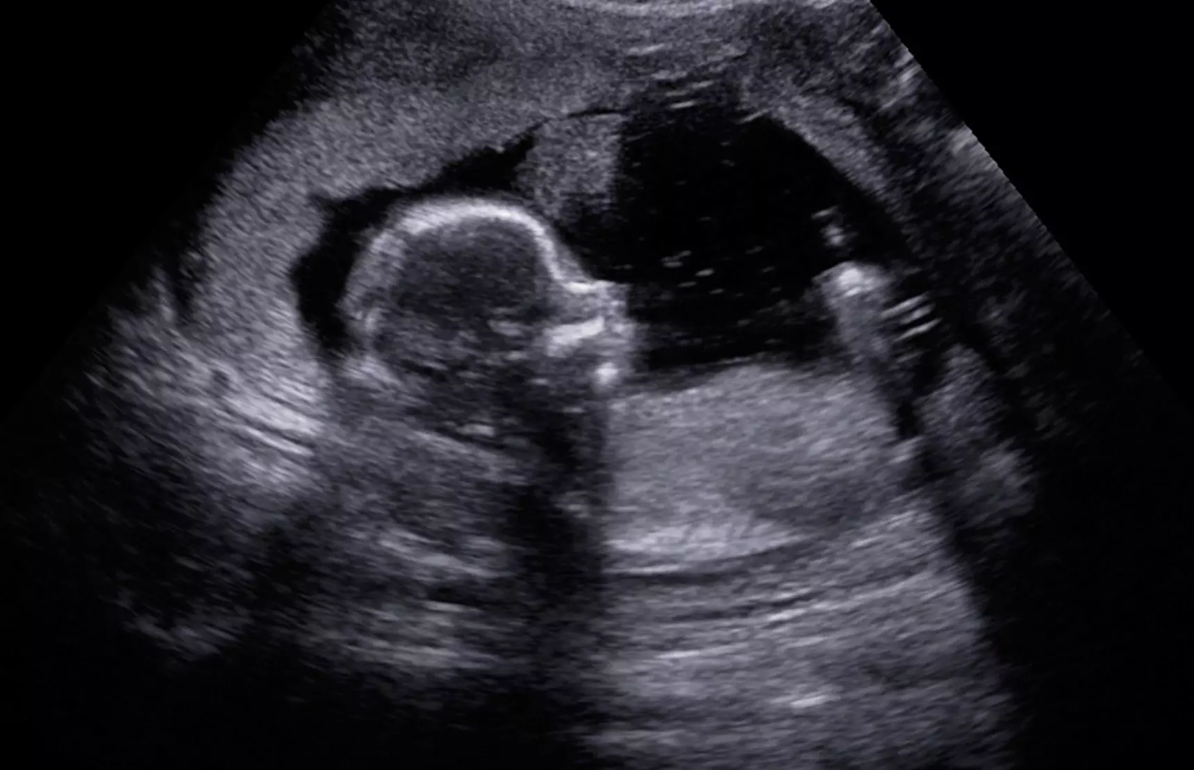 Fetal heartbeat misinformation must be met with science and truth