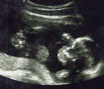 Kentucky judge dismisses life at conception as a ‘Christian and Catholic belief’