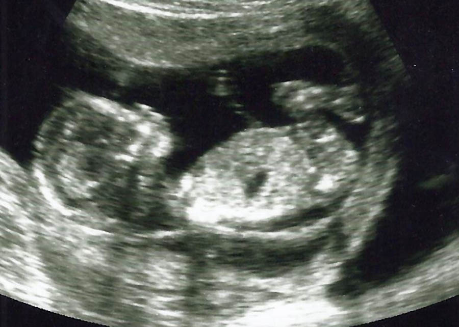 The question of when life begins is back in play