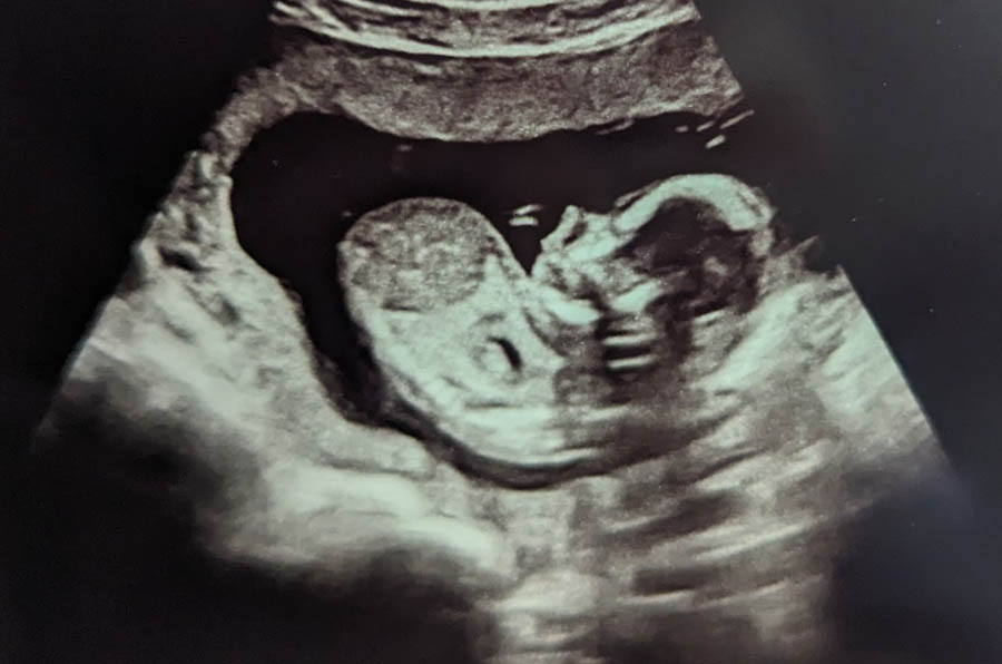 Sarah’s story of Abortion Pill Reversal