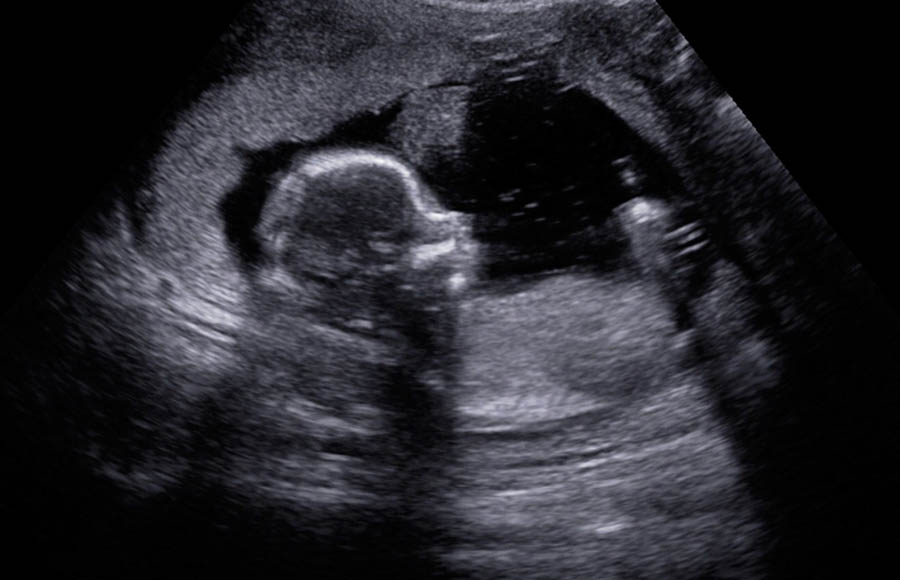 Fetal heartbeat misinformation must be met with science and truth